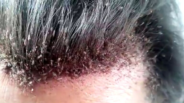 Severe Head Lice Infestation | Nitpro