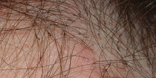 Heavy Head Lice Infestation | Nitpro